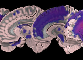 MRI Stroke Data Set Released
