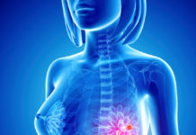 NIR light may identify breast cancer patients who will benefit most from chemotherapy