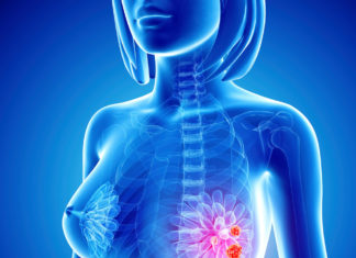 NIR light may identify breast cancer patients who will benefit most from chemotherapy