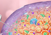 New therapeutic gel shows promise against cancerous tumors