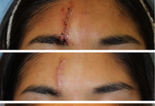 Patients and doctors often disagree in evaluation of surgical scarring