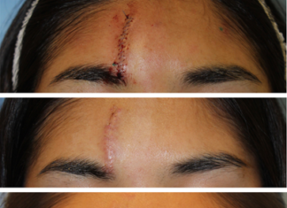 Patients and doctors often disagree in evaluation of surgical scarring