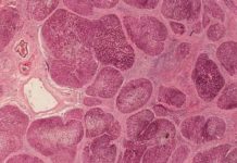Preventing fibrosis