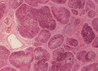 Preventing fibrosis