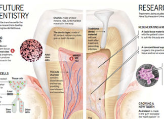 Researcher uses stem cells to attack bacteria and regenerate dental pulp