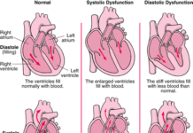 Researchers identify potential treatment for diastolic dysfunction in heart failure