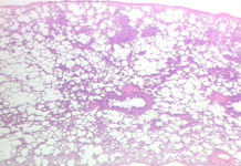 Researchers report first lung stem cell transplantation clinical trial
