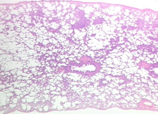 Researchers report first lung stem cell transplantation clinical trial