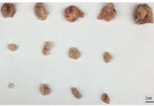 Scientists target glioma cancer stem cells, which could improve patient survival