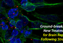Stem Cell Based Stroke Treatment Repairs Brain Tissue