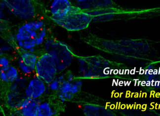 Stem Cell Based Stroke Treatment Repairs Brain Tissue