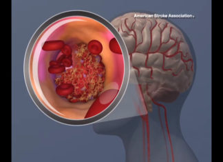 Stroke risk factors unique to women identified
