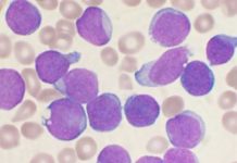 Study: CAR T-cell therapy safe and effective in youth with leukemia