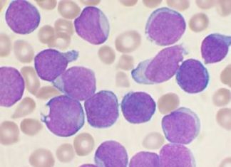 Study: CAR T-cell therapy safe and effective in youth with leukemia