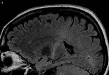 Therapeutic antibodies protected nerve–muscle connections in a mouse model of Lou Gehrig’s disease