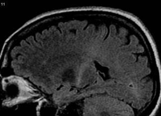 Therapeutic antibodies protected nerve–muscle connections in a mouse model of Lou Gehrig’s disease