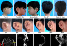 Team in China grows ears and attaches them to human patients