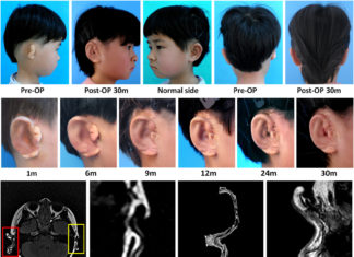 Team in China grows ears and attaches them to human patients