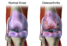 Study suggests failed osteoarthritis drug could help treat opioid addiction