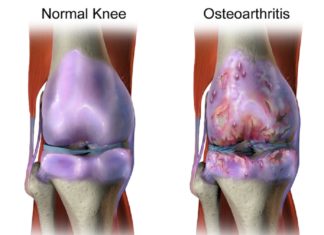 Study suggests failed osteoarthritis drug could help treat opioid addiction
