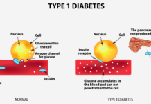 Existing drug effective at preventing onset of type 1 diabetes in 60% of patients