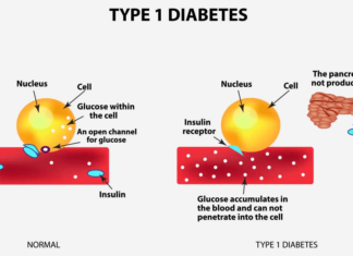 Existing drug effective at preventing onset of type 1 diabetes in 60% of patients