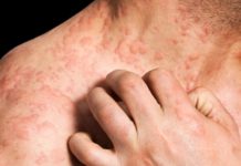 A new tactic for eczema? A newly identified brake on the allergic attack