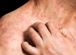 A new tactic for eczema? A newly identified brake on the allergic attack
