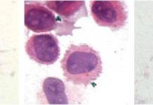How tattoos are maintained by macrophages could be key to improving their removal