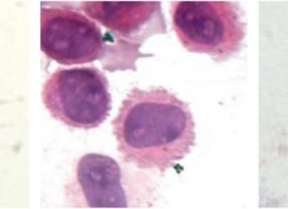 How tattoos are maintained by macrophages could be key to improving their removal