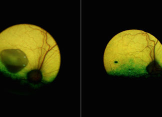 New gene therapy corrects a form of inherited macular degeneration in canine model