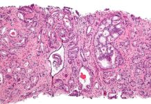 One-off PSA screening for prostate cancer does not save lives