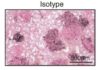 Preventing tumors from shedding their identifying proteins allows immune system to attack