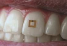 Scientists develop tiny tooth-mounted sensors that can track what you eat