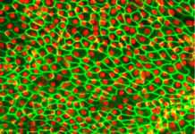Stem cells treat macular degeneration