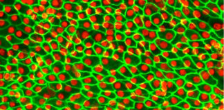 Stem cells treat macular degeneration