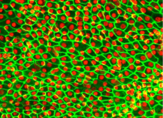 Stem cells treat macular degeneration