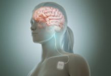 Vagus Nerve Stimulation Boosts Post-Stroke Motor Skill Recovery