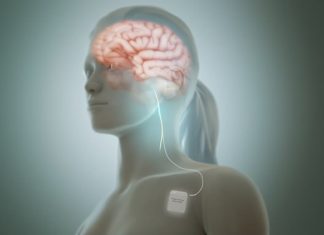 Vagus Nerve Stimulation Boosts Post-Stroke Motor Skill Recovery