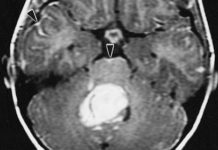Study helps explain launch switch for most common malignant pediatric brain tumor