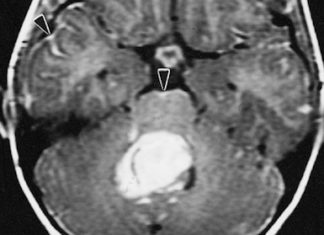 Study helps explain launch switch for most common malignant pediatric brain tumor
