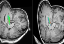 Brain Structure Linked to Symptoms of Restless Leg Syndrome