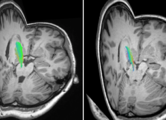 Brain Structure Linked to Symptoms of Restless Leg Syndrome