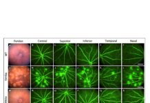 Fighting diabetic blindness: Researchers develop new target to study potential treatments