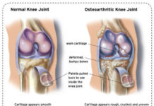 Get off the golf cart if you have knee osteoarthritis