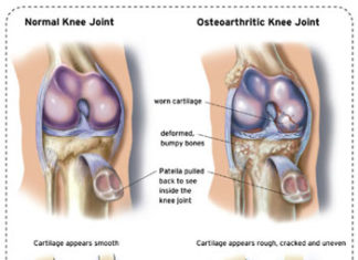 Get off the golf cart if you have knee osteoarthritis