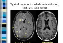 Is whole-brain radiation still best for brain metastases from small-cell lung cancer?