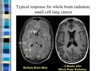 Is whole-brain radiation still best for brain metastases from small-cell lung cancer?