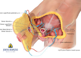 Johns Hopkins performs first total penis and scrotum transplant in the world