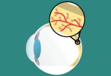 Macular degeneration linked to aging immune cells